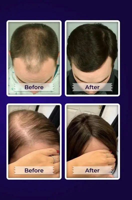 FEG Hair Revival Spray – Stop Hair Fall, Restore Confidence