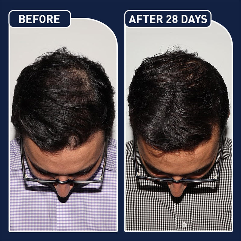 FEG Hair Revival Spray – Stop Hair Fall, Restore Confidence