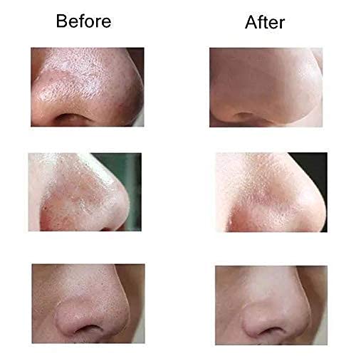 Glow with Confidence — Premium Deep Pore Blackhead Remover